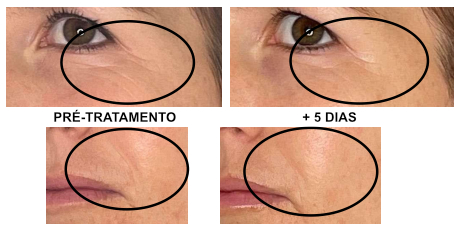 protocolo cicatrizes acne