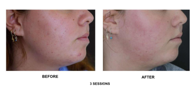 Microneedling Scars and Acne Protocol en