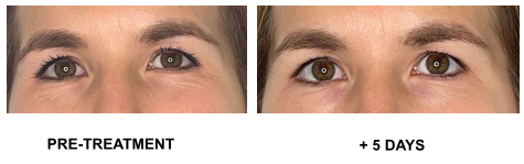 Microneedling Revitalizing Protocol en