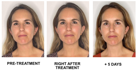 Microneedling Revitalizing Protocol 2 en