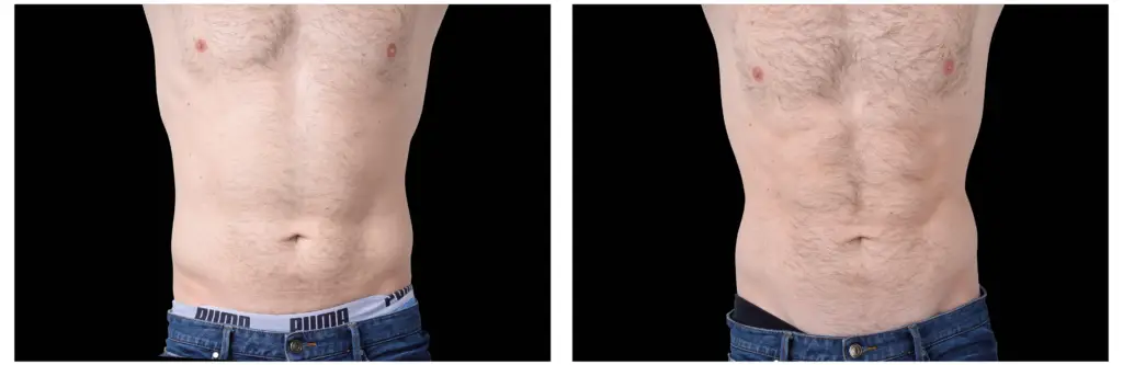 ANTES E DEPOIS ABDODMEN MAS