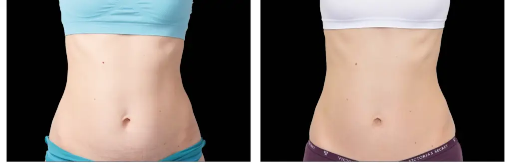 ANTES E DEPOIS ABDOMEN FEM