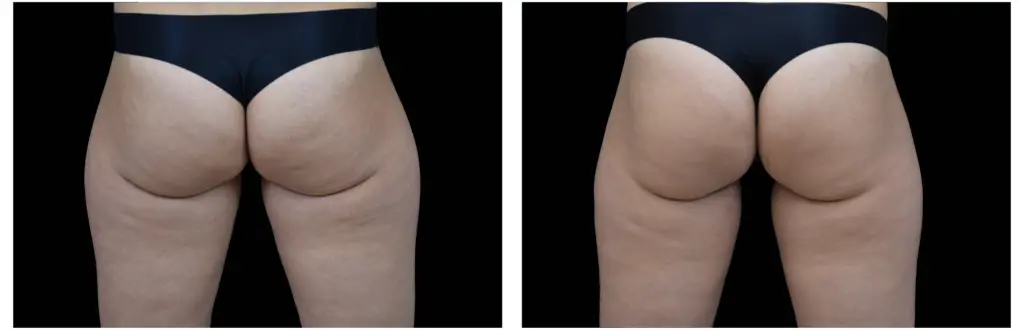 ANTES E DEPOIS GLUTEOS