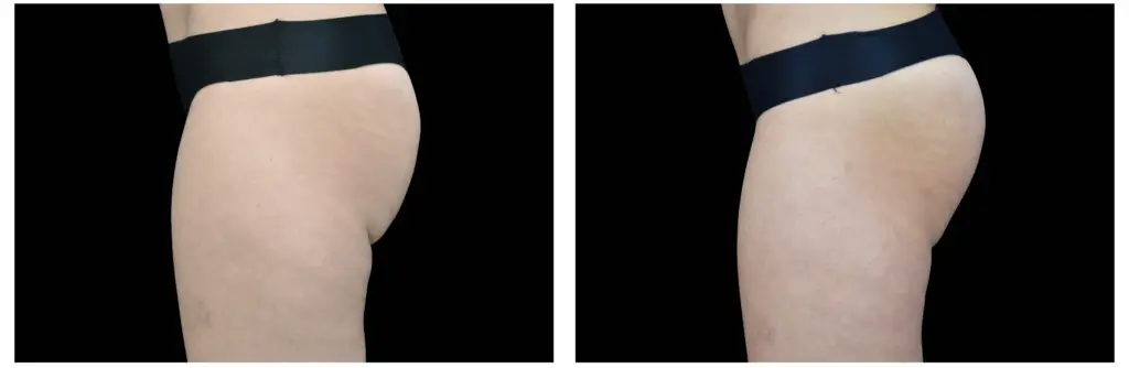 gluteos antes e depois