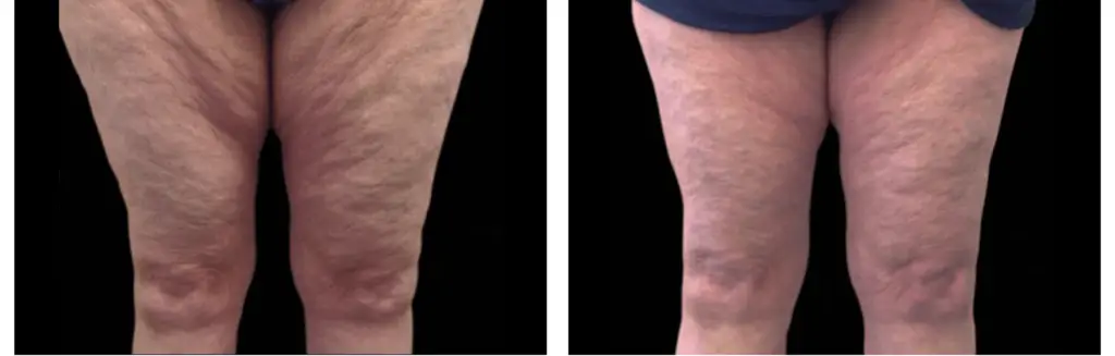 x wave antes e depois