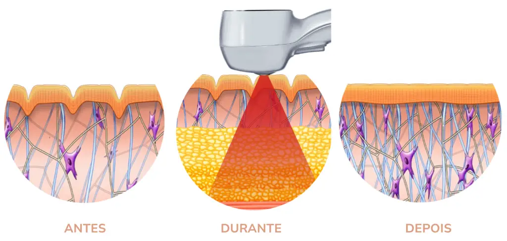 tratamento exilis corporal