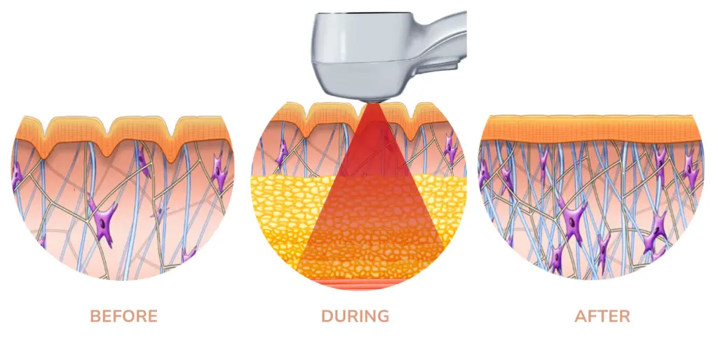 exilis body treatment