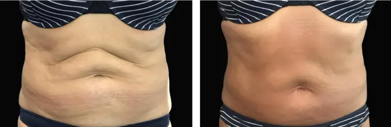 exilis-abdomen-tratamento