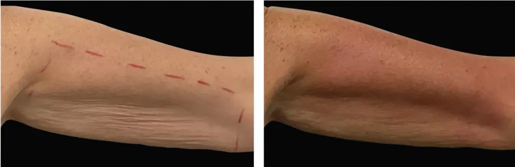 exilis-braço-tratamento