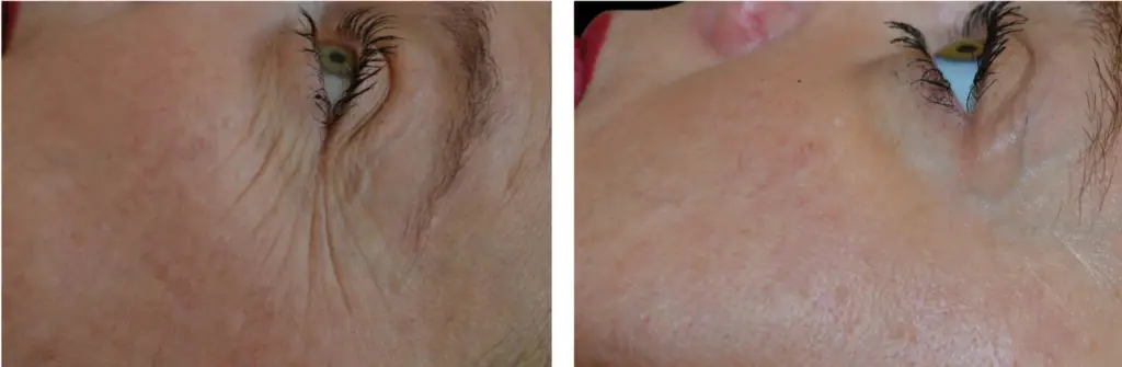 exilis-pésgalinha-tratamento