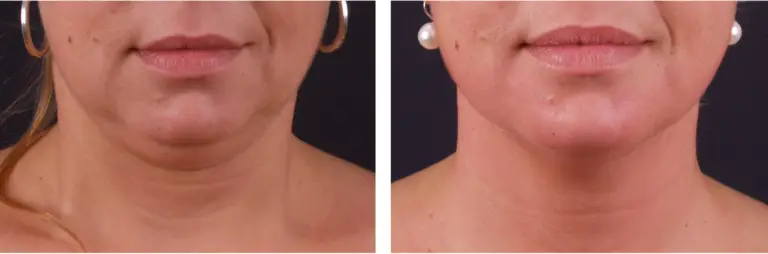 exilis-papada-tratamento