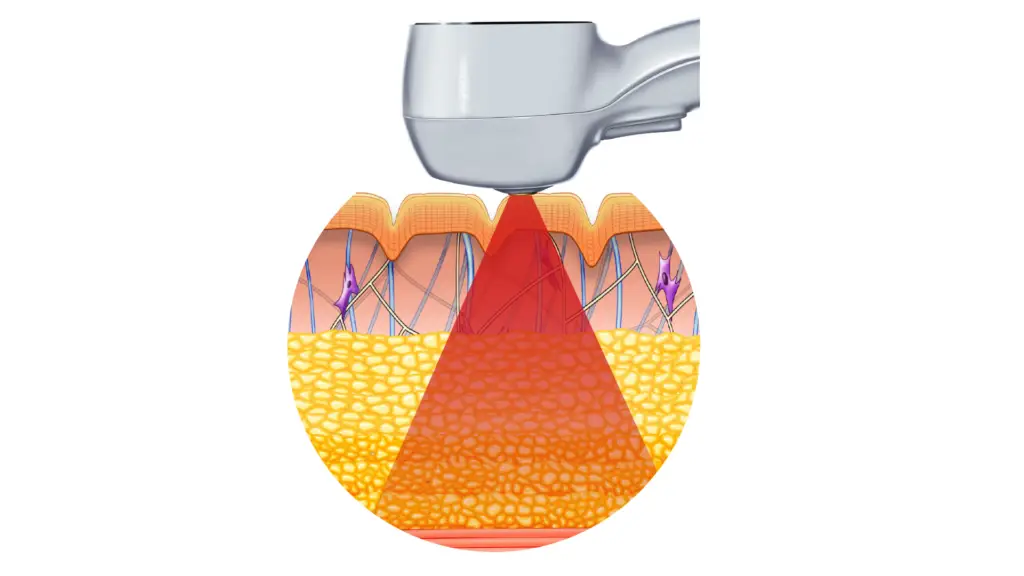 exilis-ultra-360-corpo