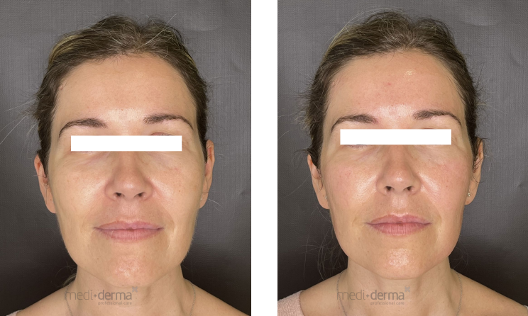 Antes e depois 1 sessão