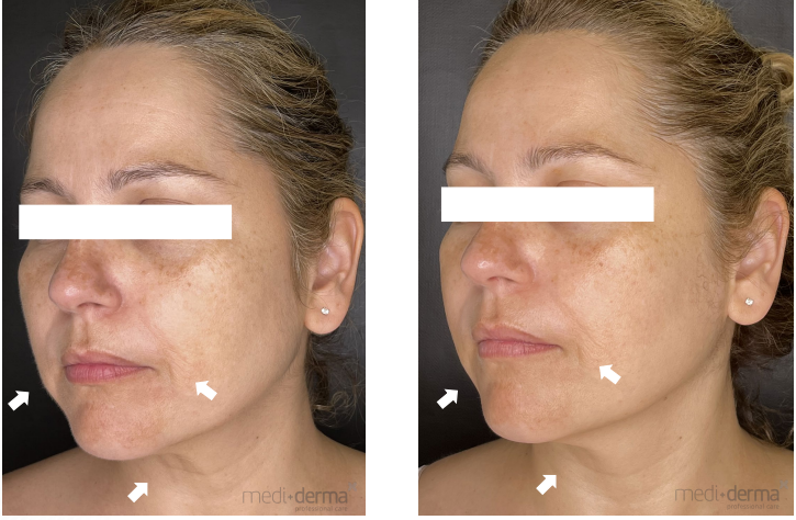 Antes e depois 2 sessões